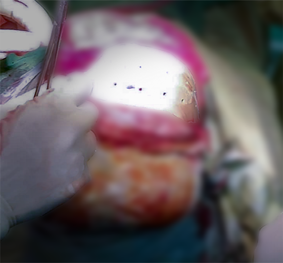 Cranium PEEK implant case 05